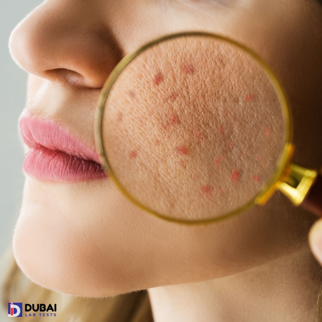 Skin Analysis