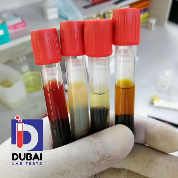 Alpha-1-Antitrypsin (AAT) Serum Test