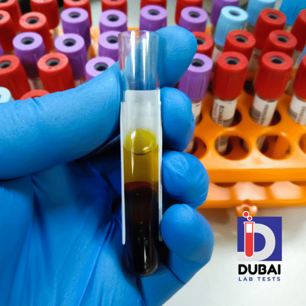 Carbohydrate Deficient Transferrin test
