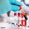 HLA-PRA Screening (Class I & II) Panel Reactive antibody